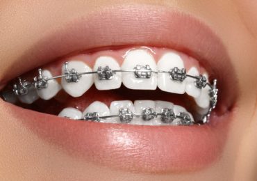 Close-up of dental braces on teeth Silver