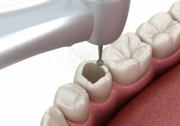 tooth filling itreatment