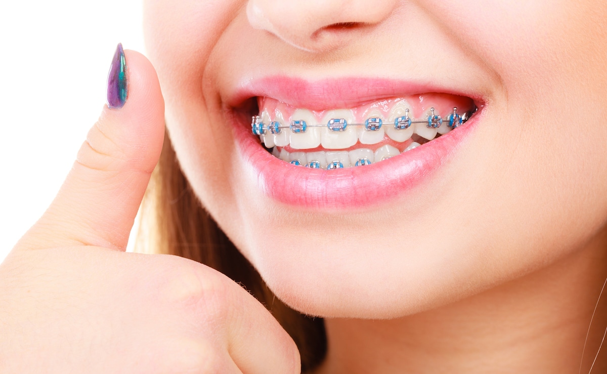 Dental braces on teeth